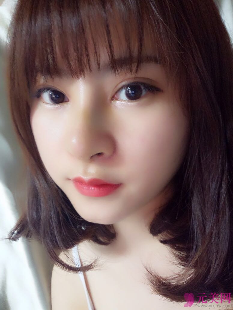 郑州星艺王慧君假体隆鼻和缩鼻翼真人隆鼻案例