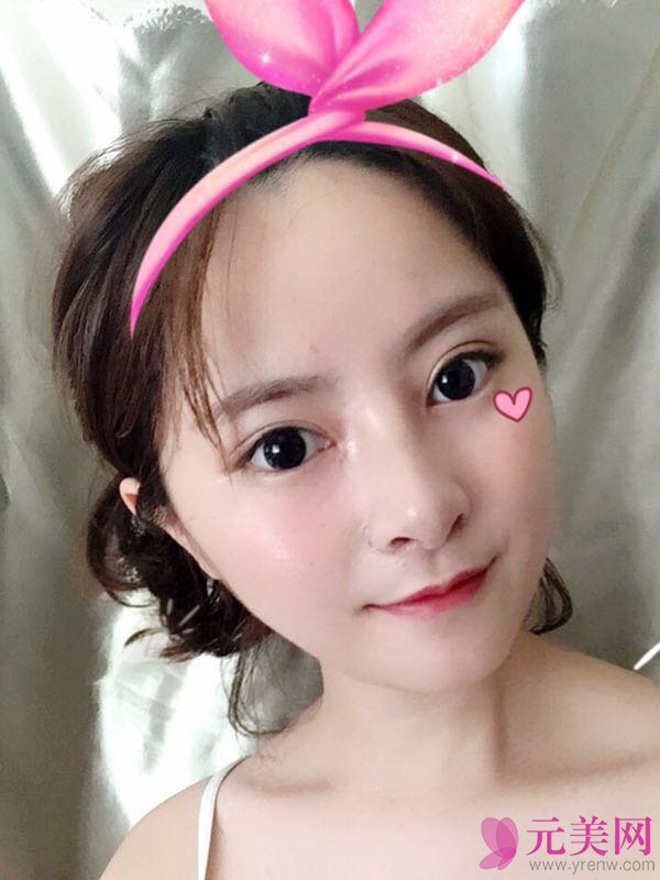 郑州星艺王慧君假体隆鼻和缩鼻翼真人隆鼻案例