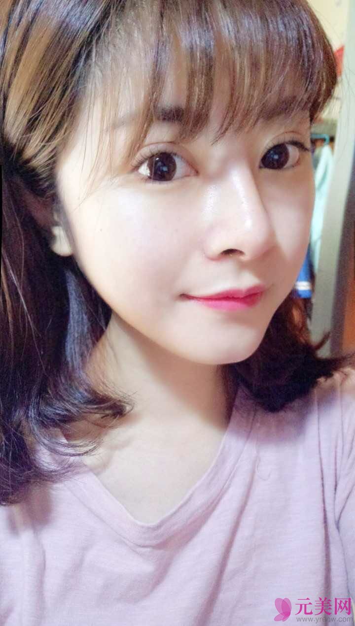 郑州星艺王慧君假体隆鼻和缩鼻翼真人隆鼻案例