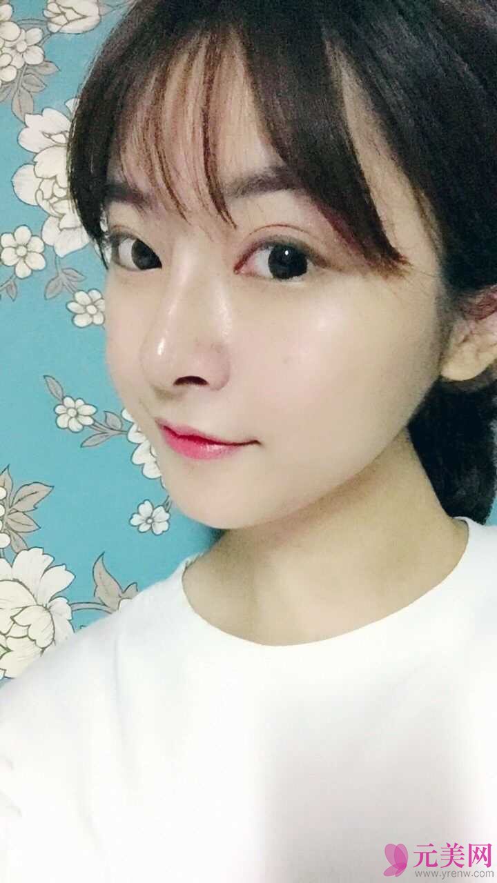 郑州星艺王慧君假体隆鼻和缩鼻翼真人隆鼻案例