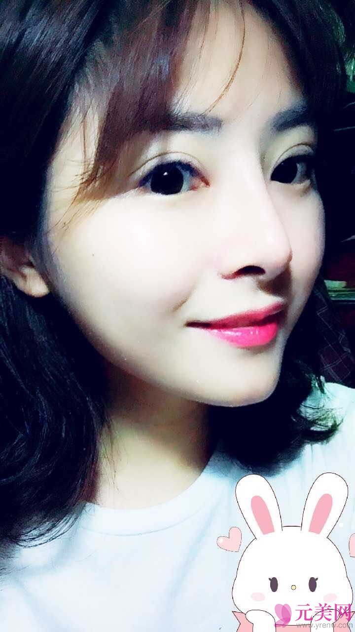 郑州星艺王慧君假体隆鼻和缩鼻翼真人隆鼻案例