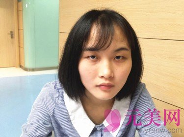 全切双眼皮+开眼角前后对比八个月恢复过程图