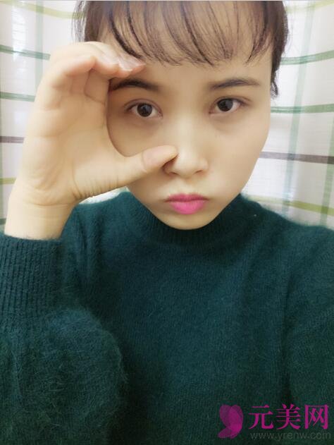 全切双眼皮+开眼角前后对比八个月恢复过程图