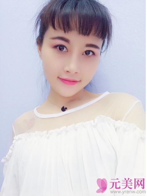 全切双眼皮+开眼角前后对比八个月恢复过程图