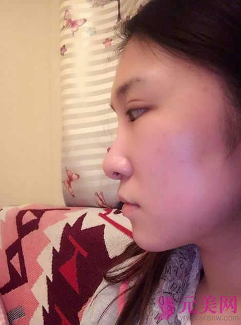 广州艺美李闯隆鼻失败修复案例恢复过程图