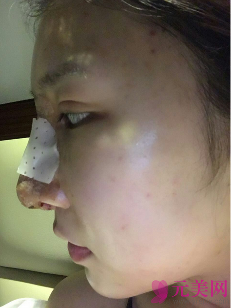广州艺美李闯隆鼻失败修复案例恢复过程图