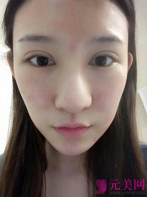 广州艺美李闯隆鼻失败修复案例恢复过程图
