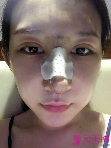 广州艺美李闯隆鼻失败修复案例恢复过程图
