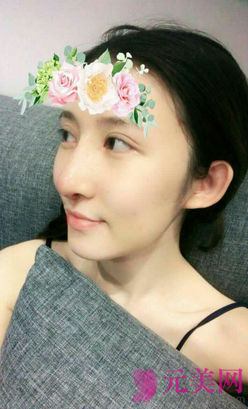 广州艺美李闯隆鼻失败修复案例恢复过程图