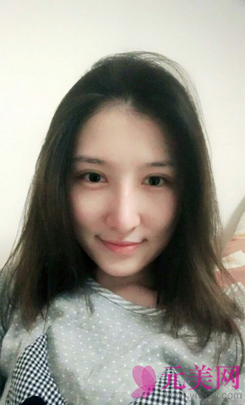 广州艺美李闯隆鼻失败修复案例恢复过程图