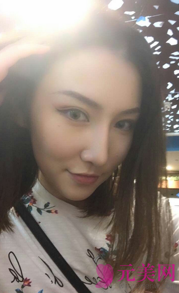 广州艺美李闯隆鼻失败修复案例恢复过程图