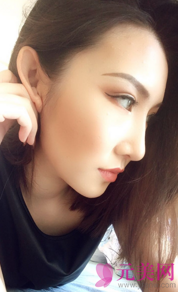 广州艺美李闯隆鼻失败修复案例恢复过程图
