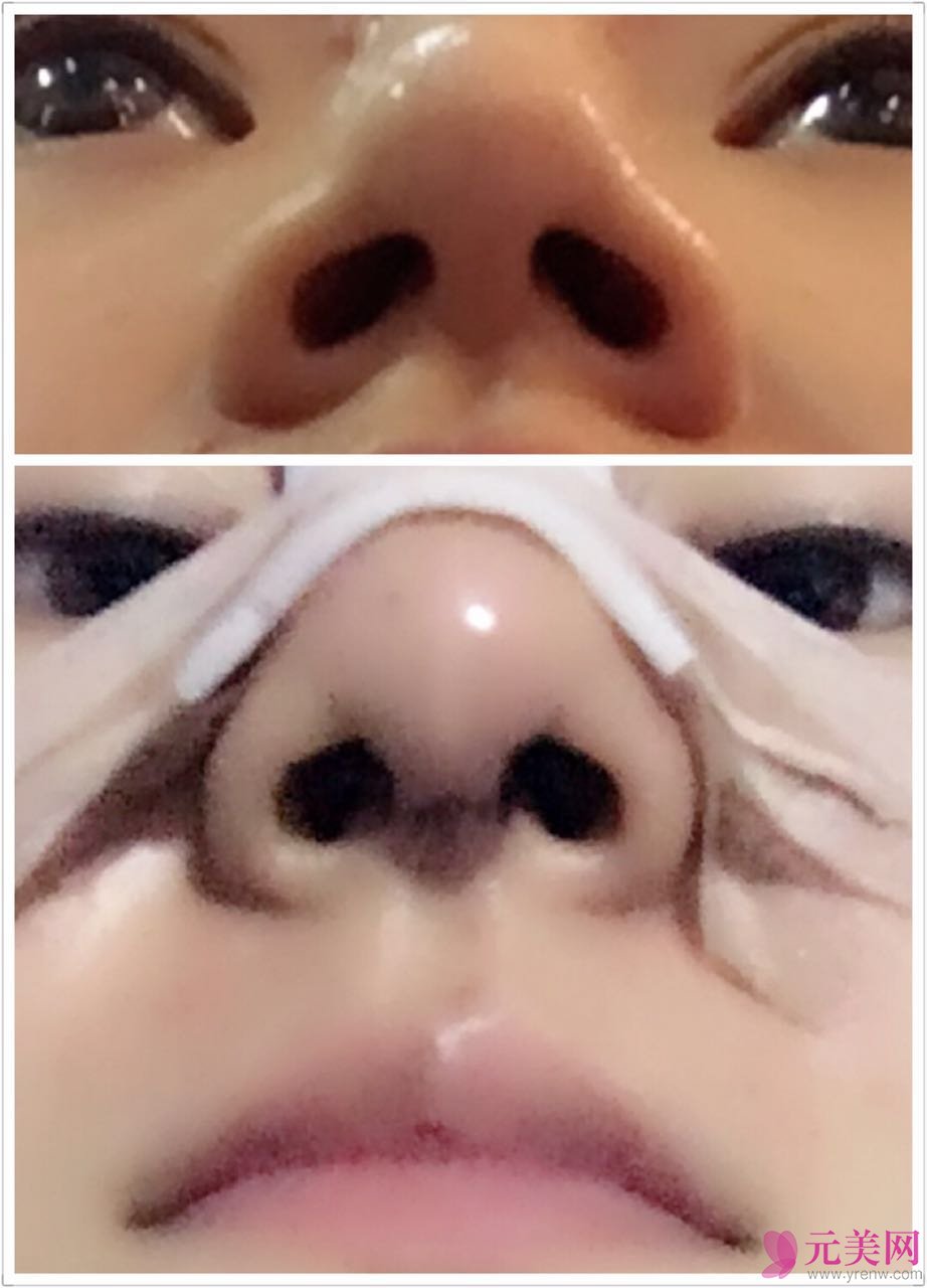 北京炫美张海龙鼻部手术真人案例恢复图