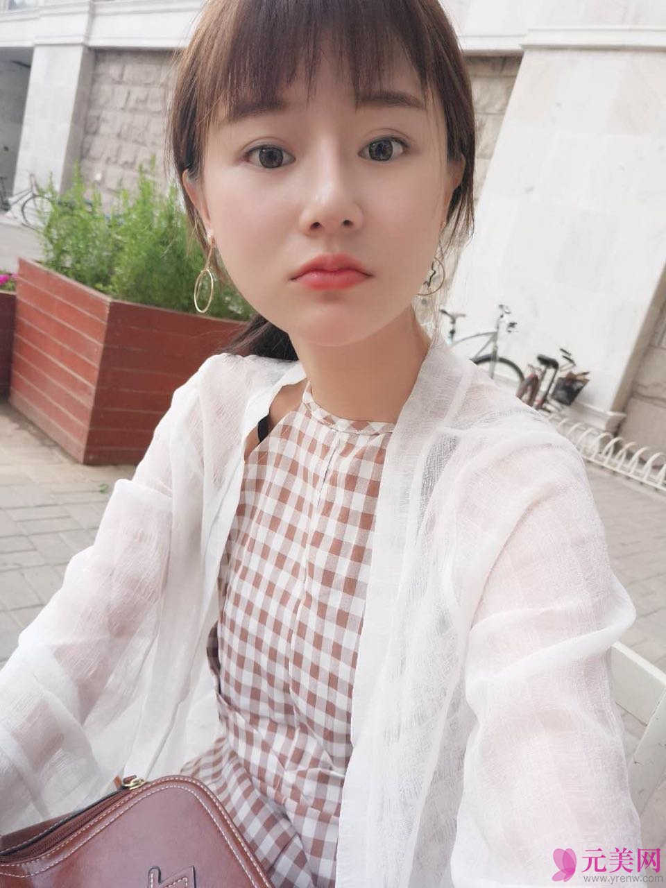 北京炫美张海龙鼻部手术真人案例恢复图
