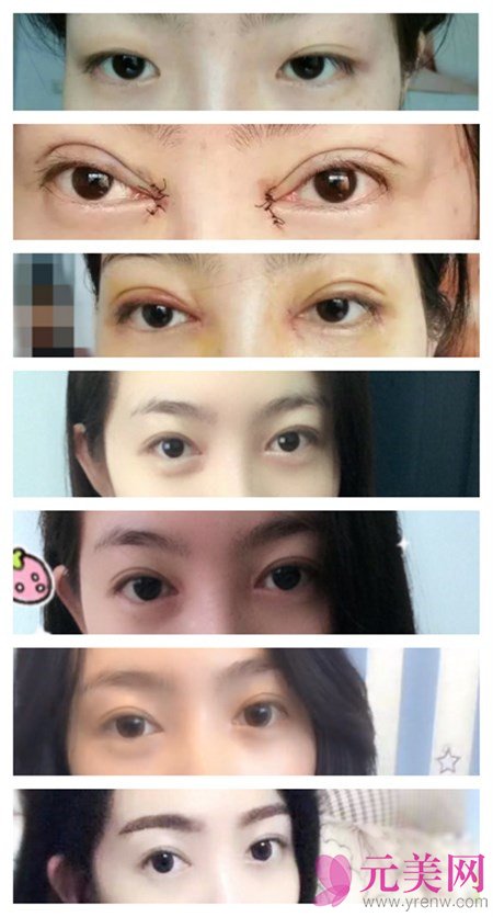 北京俯大褚福海双眼皮修复+开内眼真人案例