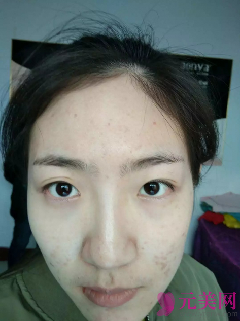 北京俯大褚福海双眼皮修复+开内眼真人案例