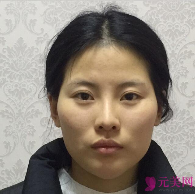 北京炫美徐学东自体脂肪填充面部真人案例