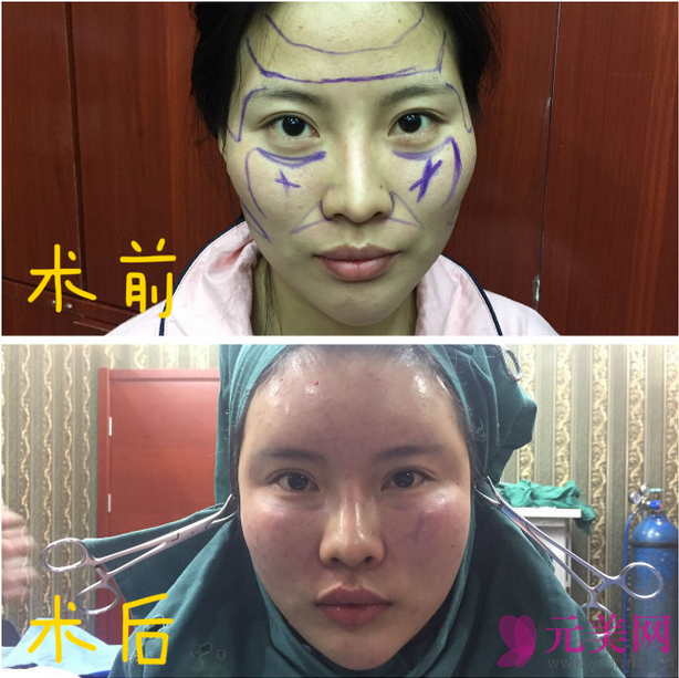 北京炫美徐学东自体脂肪填充面部真人案例