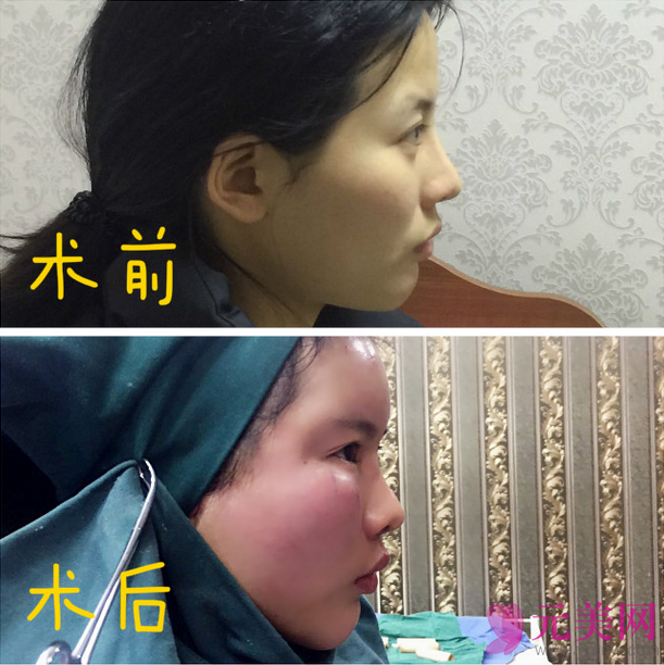 北京炫美徐学东自体脂肪填充面部真人案例