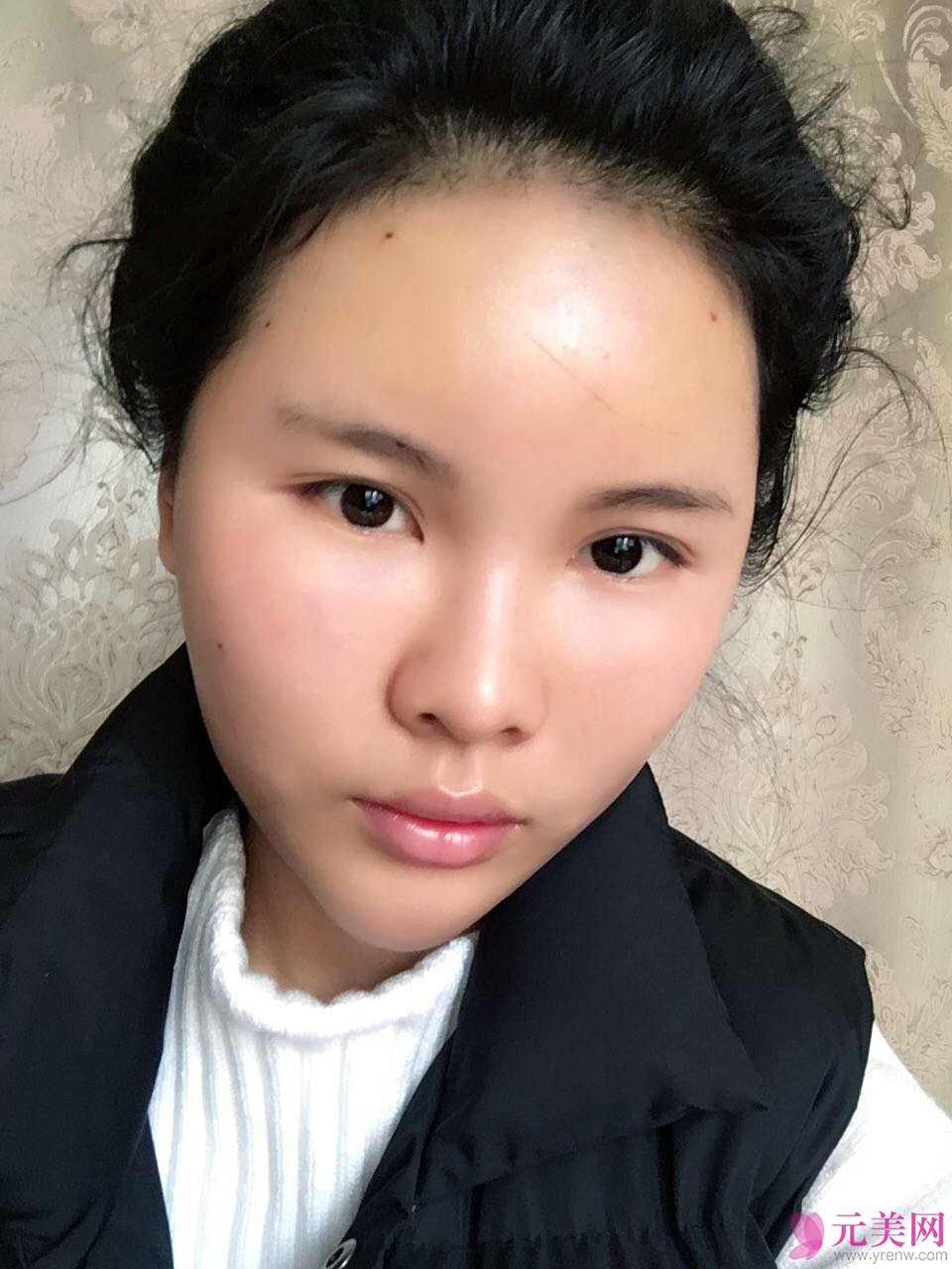 北京炫美徐学东自体脂肪填充面部真人案例