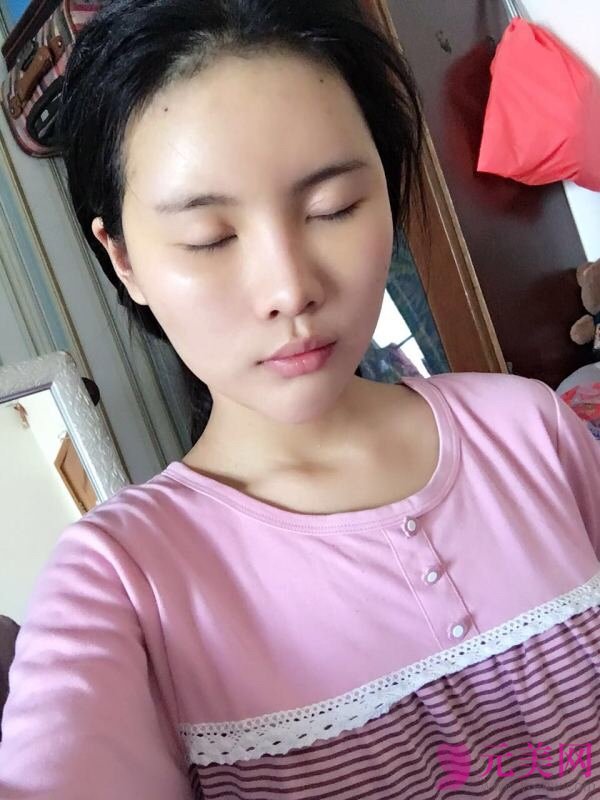 北京炫美徐学东自体脂肪填充面部真人案例