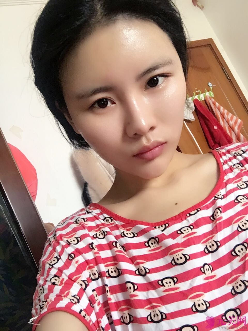 北京炫美徐学东自体脂肪填充面部真人案例