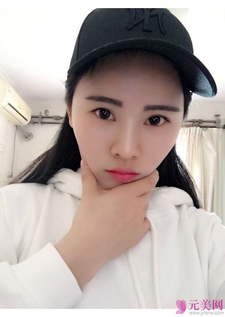 北京炫美徐学东自体脂肪填充面部真人案例