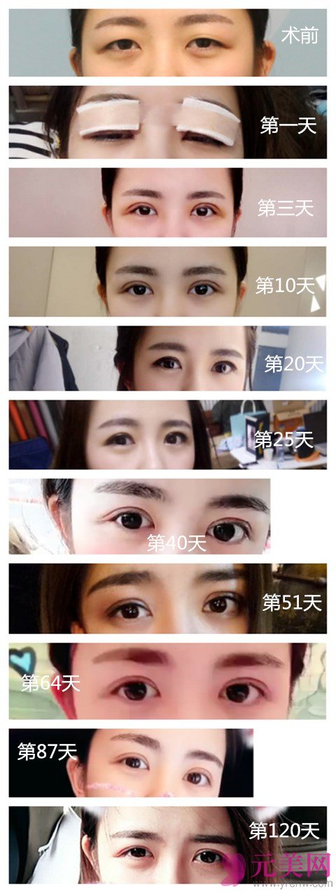 北京眼部手术全切双眼皮+开眼角真人案例恢复照