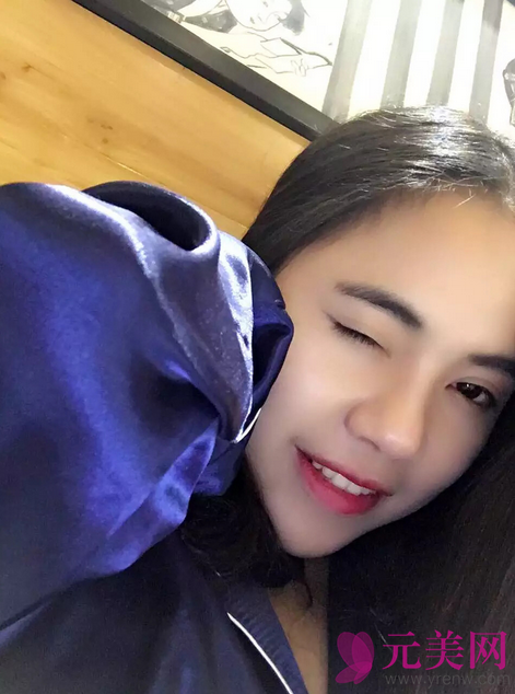 广州艺美张涛自体脂肪填充面部+全切双眼皮案例