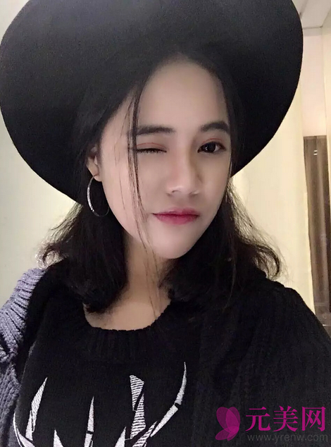 广州艺美张涛自体脂肪填充面部+全切双眼皮案例