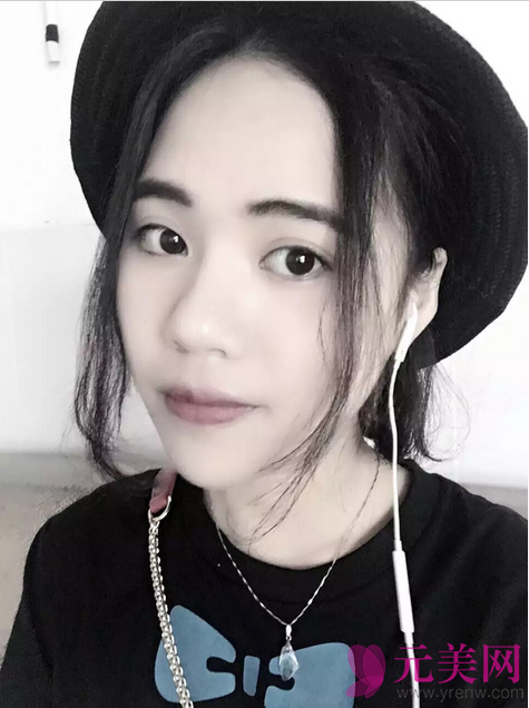 广州艺美张涛自体脂肪填充面部+全切双眼皮案例