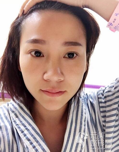 自体脂肪填充术前
