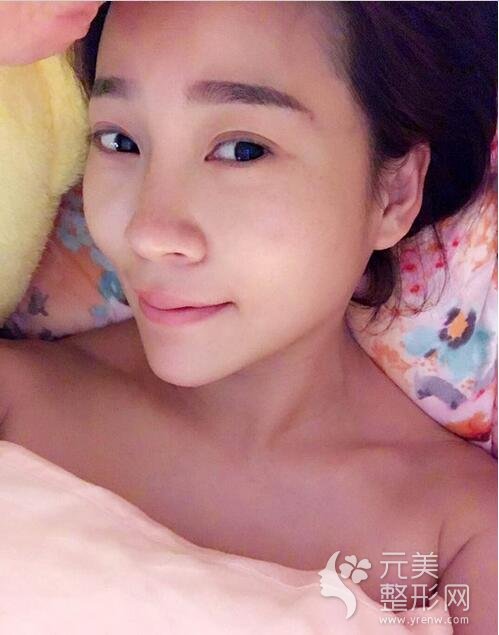 自体脂肪填充术前