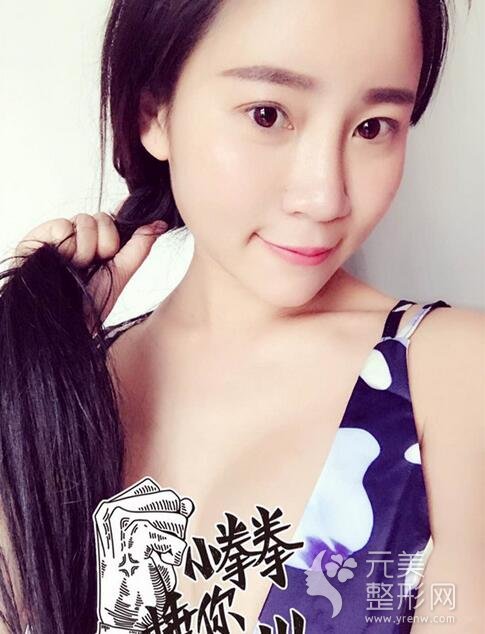 自体脂肪填充16天