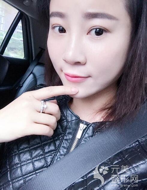 自体脂肪填充23天