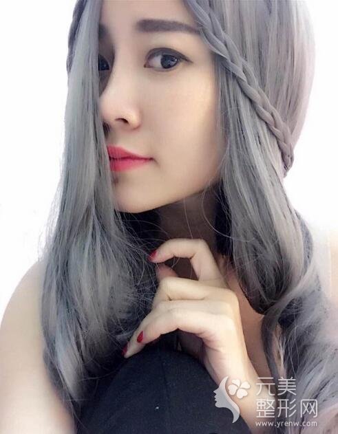 自体脂肪填充一个月