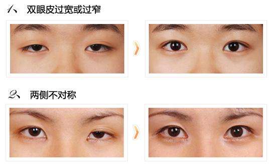 需要修复的双眼皮.jpg