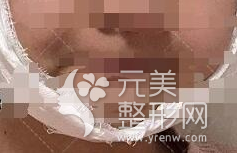 北京八大处滕利下颌角案例