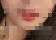 北京八大处滕利下颌角案例