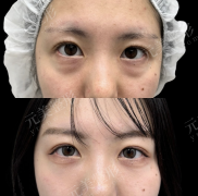 八大处做眼袋哪个大夫好？32岁宝妈60天逆袭，2025年这6位才是真口碑！