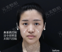 八大处自体脂肪填充全脸哪个医生好？＂花3.8万做全脸填充，闺蜜说我像换了张脸！＂ 选错医生，脂肪成活率差一半